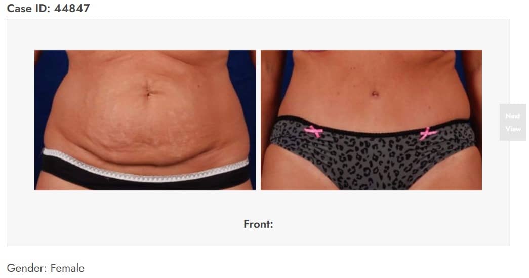 Best tummy tuck revision, Our Surgical Team
