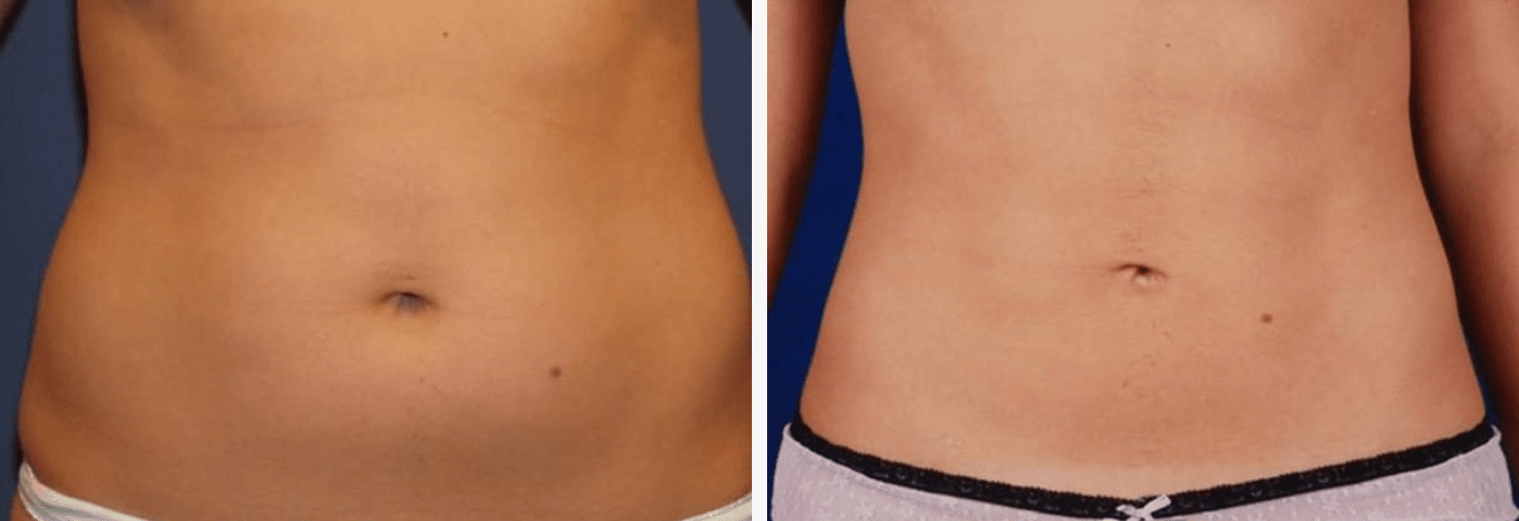 St Louis Flank and Hip Liposuction Procedure